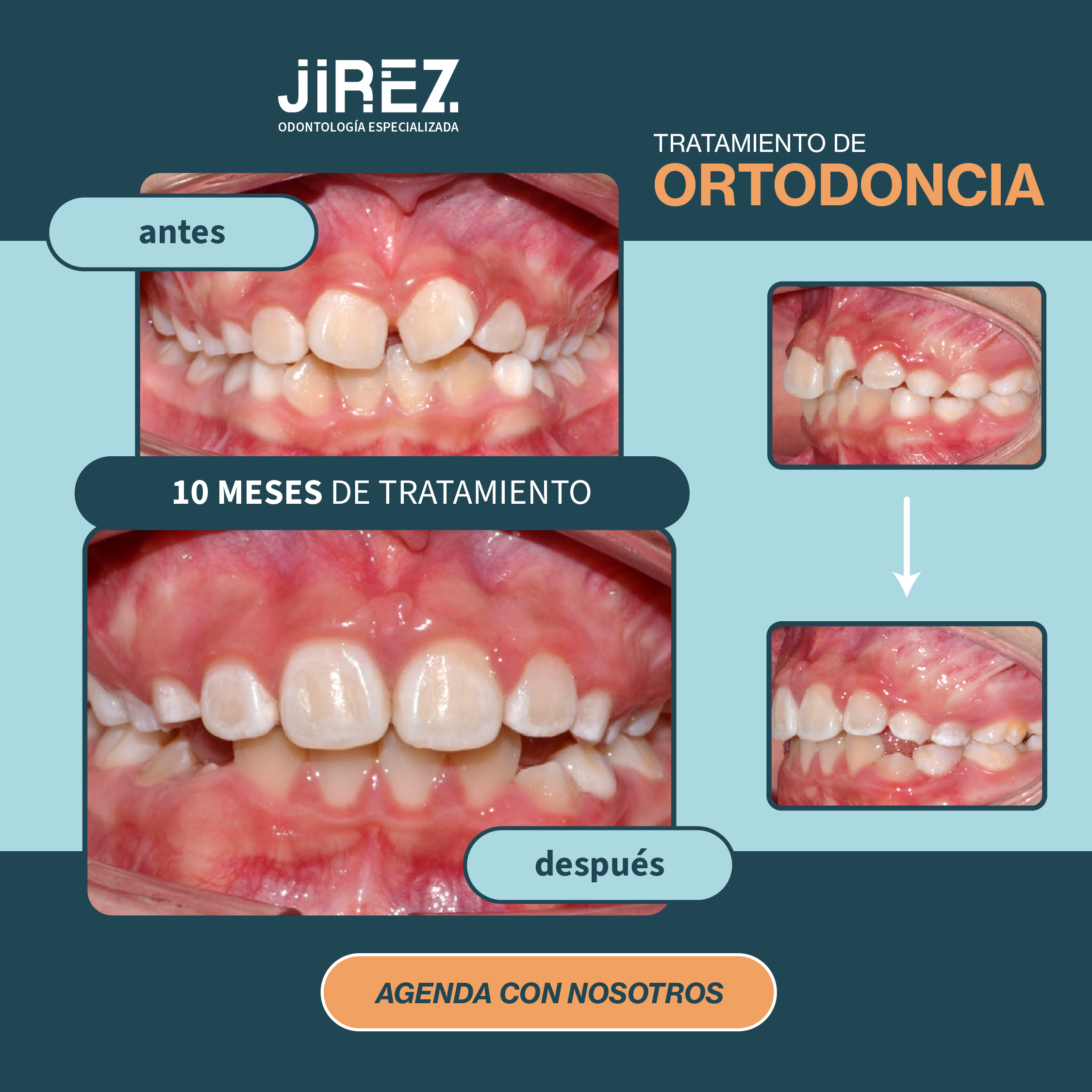 Antes y después ortodoncia caso 1