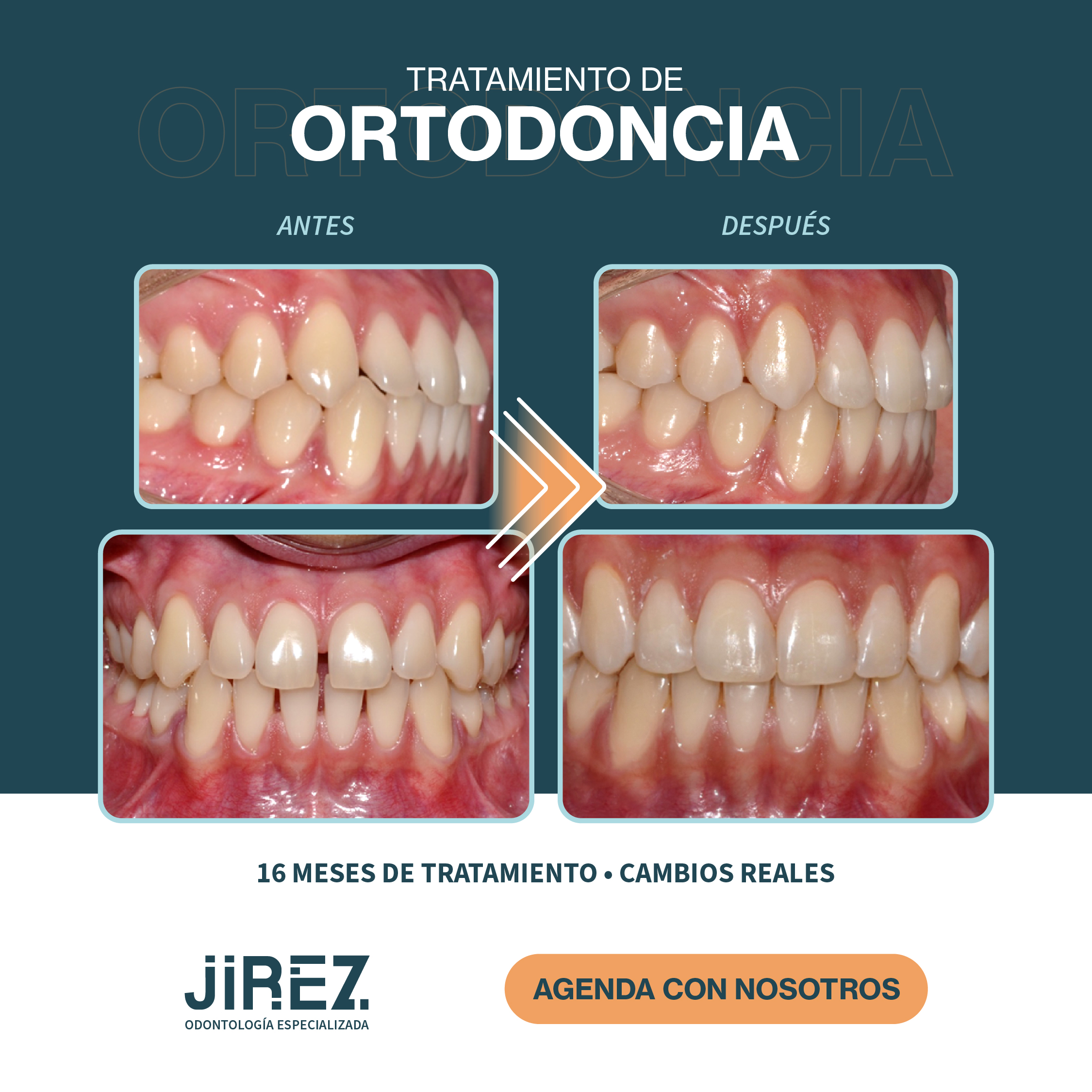 Antes y después ortodoncia caso 2