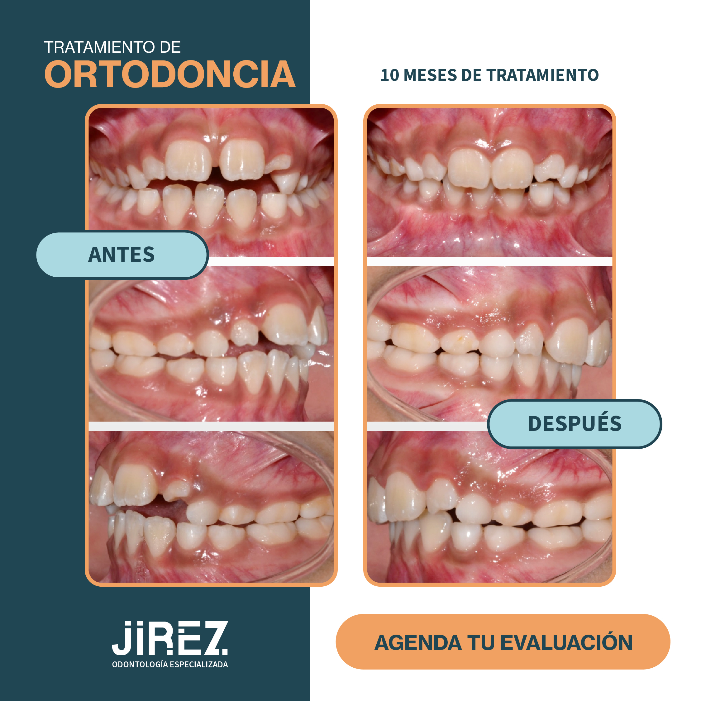 Antes y después ortodoncia caso 3