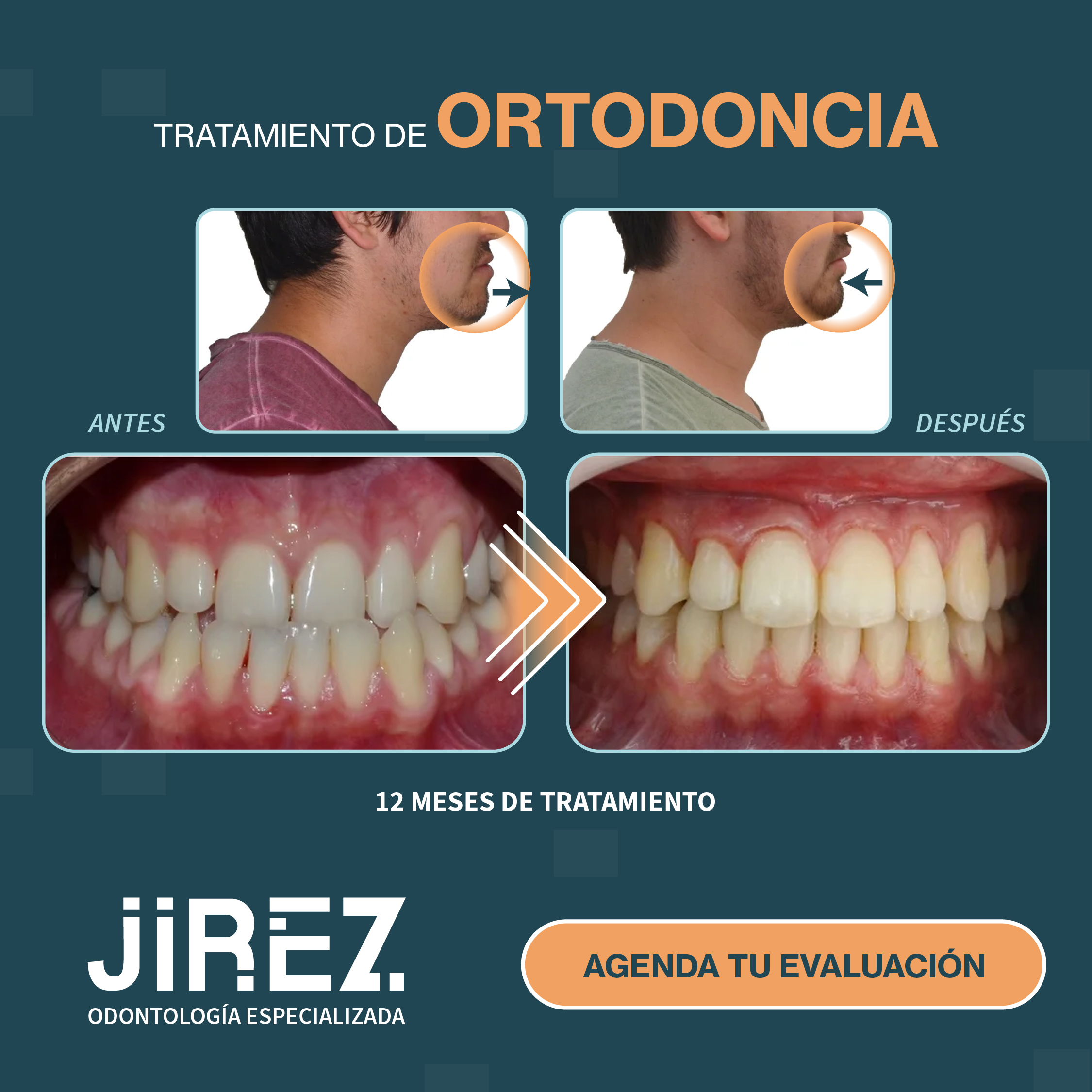 Antes y después ortodoncia caso 4